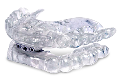 Sleep apnea oral appliance, looking like a clear plastic impression of the upper and lower teeth